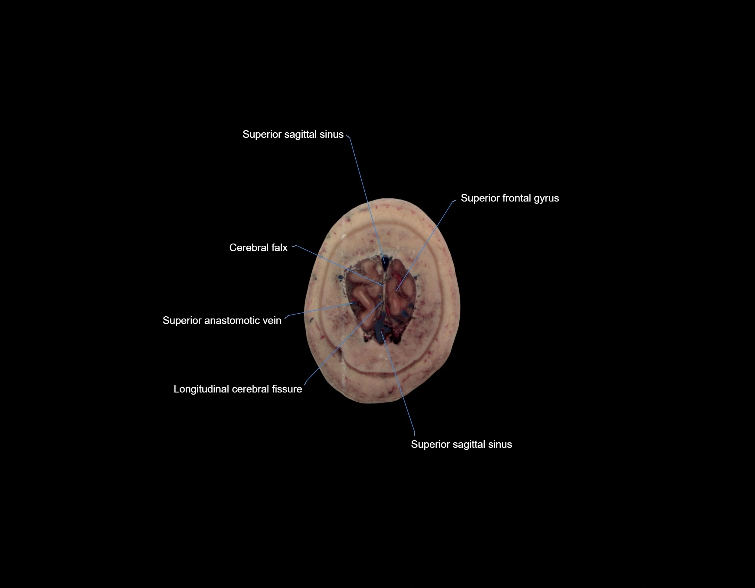 MRI Brain axial cross sectional radiology anatomy 3T image  -img-000075.webp